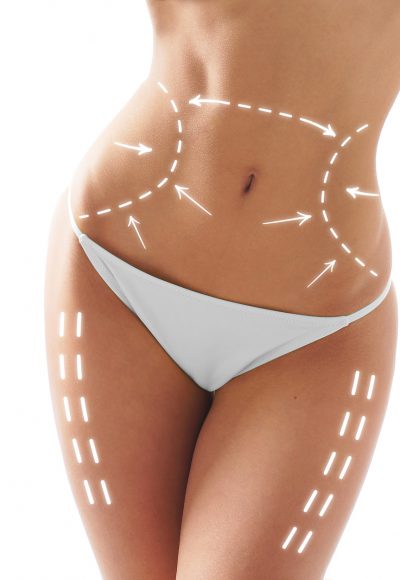 Die 10 besten Tipps gegen Cellulite