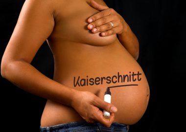 Kaiserschnitt: Alle wichtigen Infos auf einen Blick!