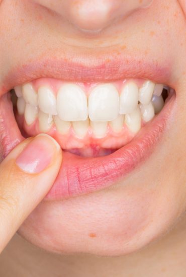 Arzt klärt auf: Das Schlimmste, was man seinen Zähnen antun kann!