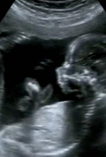 Neugeborenes mit eigenem Zwilling „schwanger“