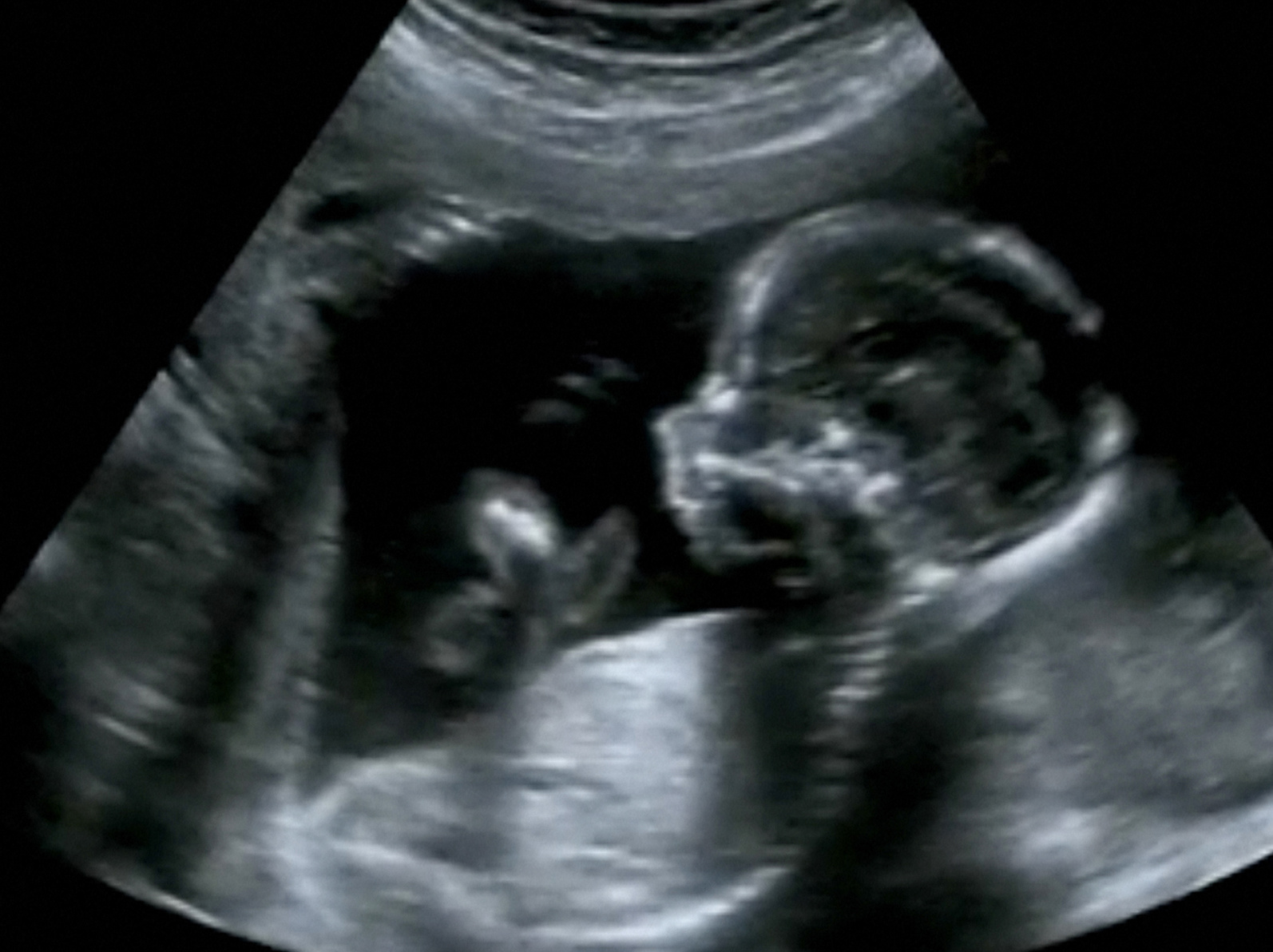 Neugeborenes mit eigenem Zwilling schwanger