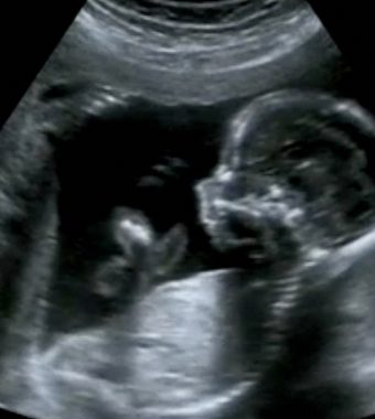 Fast gestorben – Baby tritt riesiges Loch in Gebärmutter!